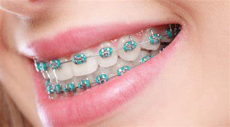 Dental Braces in Chennai: Everything You Need to Know